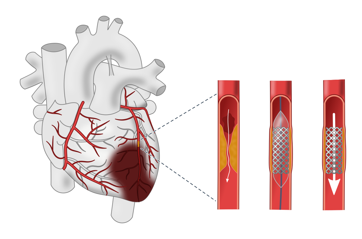 Myocardial Infarction (MI) » PHARMACAREERS